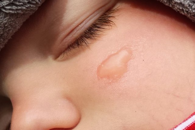 Der Bärenklau verursacht in Kombination mit Sonnenlicht mit Wasser gefüllte Blasen, wie hier bei diesem Kind. | Foto: Magalski