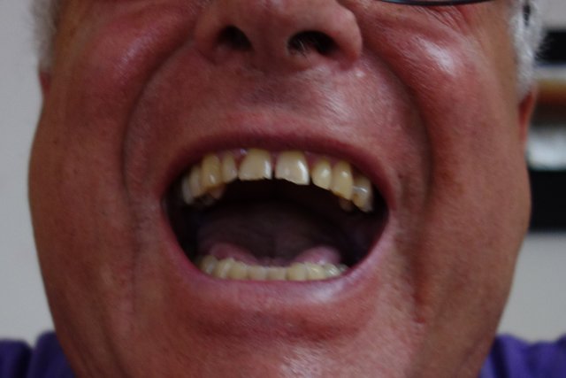 ...vor der Zahnreinigung...