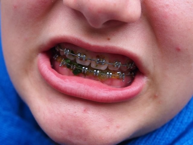 Geliebte feste Zahnspange