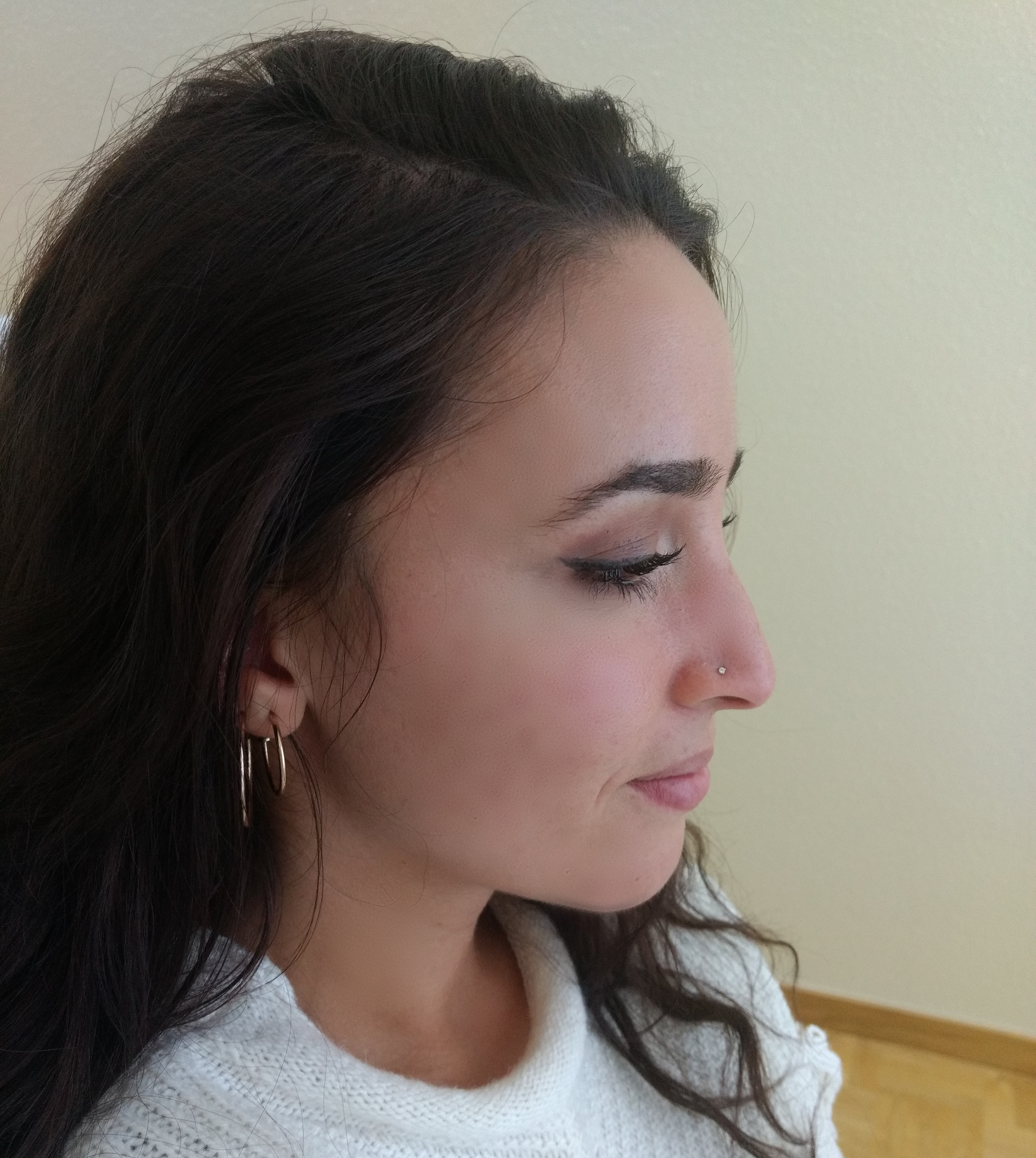 Wahnsinn - nach zehn Monaten mit der Plasma-Therapie hat sich das Hautbild von Ebru Sevikoglu (25) deutlich verbessert.