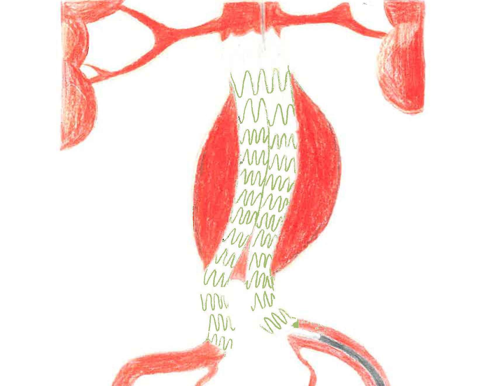 Die Aussackung der Hauptschlagader (roter Bereich in der Mitte) kann mit einem Stent behandelt werden.