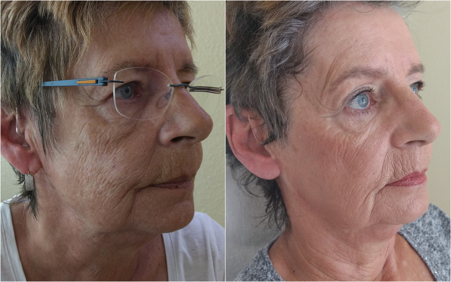 Verbesserungen des Hautbildes nach der Plasma-Therapie zeigen sich meist schon nach wenigen Anwendungen.