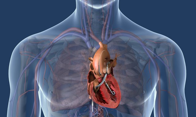Schematische Darstellung der Impella®-Herzpumpe.