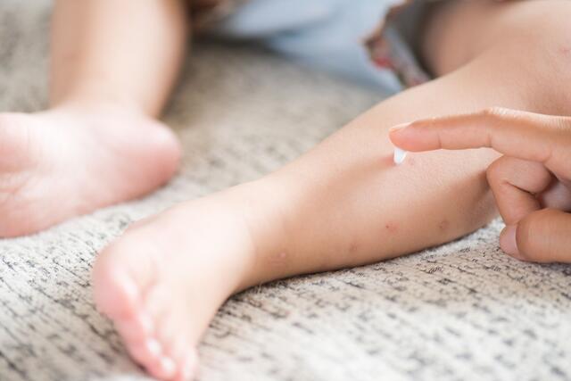 Windpocken gehören zu den häufigsten Kinderkrankheiten und sind äußerst ansteckend. Trotz des extremen Juckreizes sollten sie nicht aufgekratzt werden.