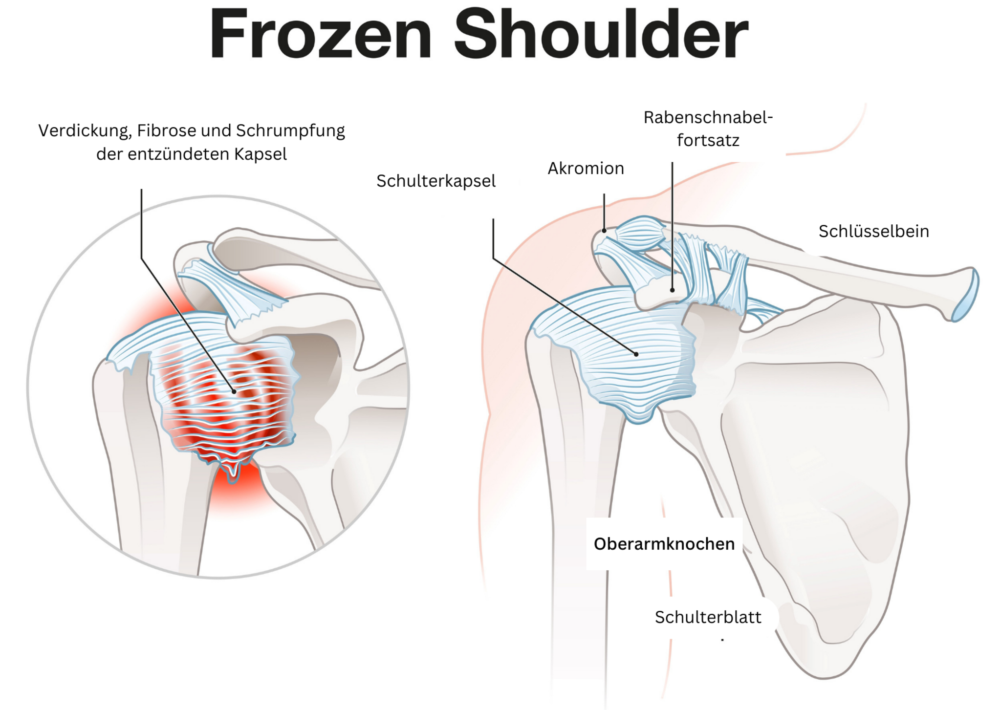 Grad Der Behinderung Bei Frozen Shoulder www.lokalkompass.de
