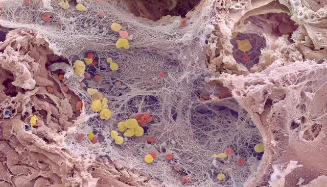 Die kolorierte rasterelektronenmikroskopische Aufnahme einer menschlichen Lunge mit COVID19-Infektion zeigt zahlreichen Lungenbläschen (Alveolen) mit Entzündungszellen (gelb), Einblutungen (rot) und hyalinen Membranen (blau).  Foto: Maximilian Ackermann