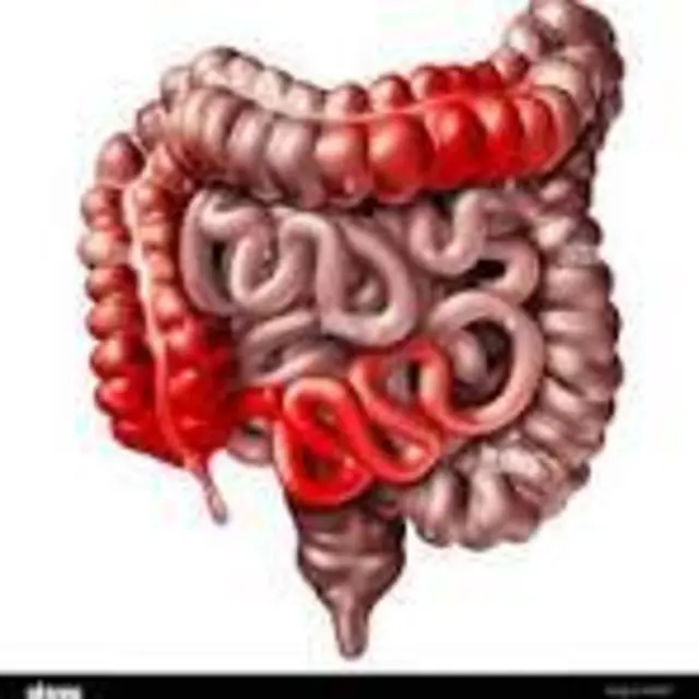 morbus crohn! „Selbsthilfe im Gespräch“ bittet das Alfried Krupp Krankenhaus in Kooperation mit der Selbsthilfeberatung Wiese e.V., 5. Februar 2026, 17 bis 18.30 Uhr, in den Berthold Beitz Saal, im Alfried Krupp Krankenhaus, Alfried-Krupp-Straße 21, Essen | Foto: Privat